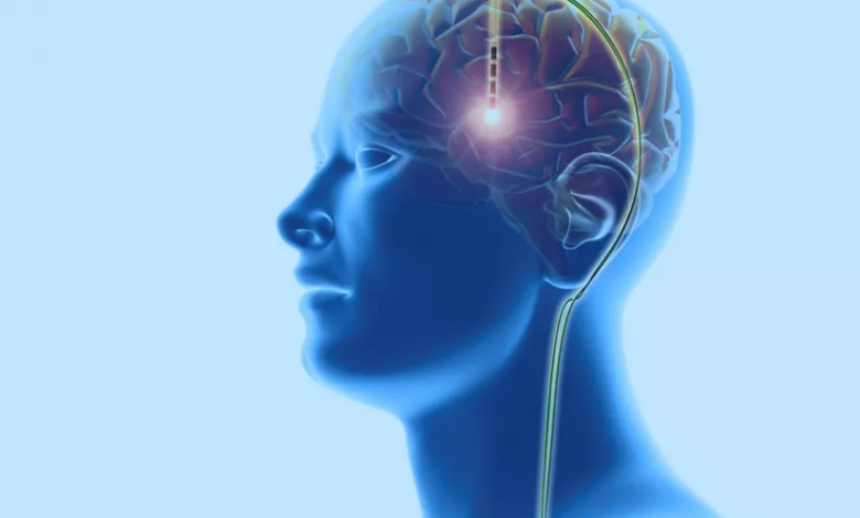 تجربة طبية رائدة لعلاج الإدمان باستخدام التحفيز العميق للدماغ